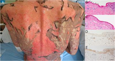 Toxic epidermal necrolysis induced by nivolumab therapy for unresectable intraperitoneal cancer